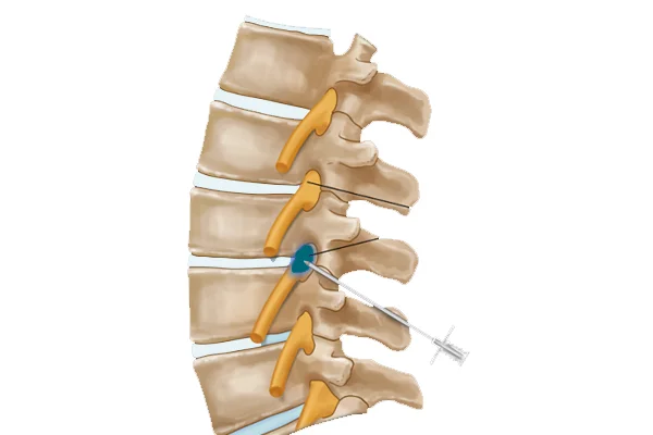 Specialized Nerve Root Block