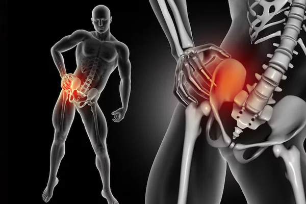 Arthritic Hip Joint Pain